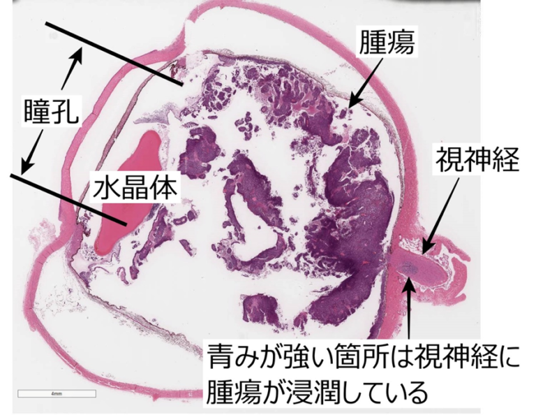 115A67 白色瞳孔を来す疾患と眼球内腫瘍（網膜芽細胞腫と悪性黒色腫） – 病理の広場