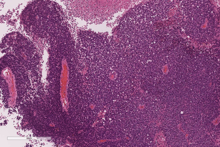 115A67 白色瞳孔を来す疾患と眼球内腫瘍（網膜芽細胞腫と悪性黒色腫） – 病理の広場