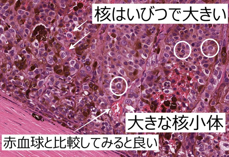 115A67 白色瞳孔を来す疾患と眼球内腫瘍（網膜芽細胞腫と悪性黒色腫） – 病理の広場