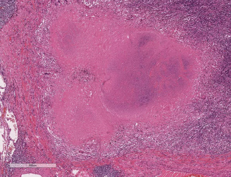 115D33 水仕事と類上皮細胞性肉芽腫、特徴的形態を示す多核巨細胞の名称について – 病理の広場