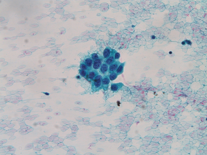 腺癌の細胞像、その２