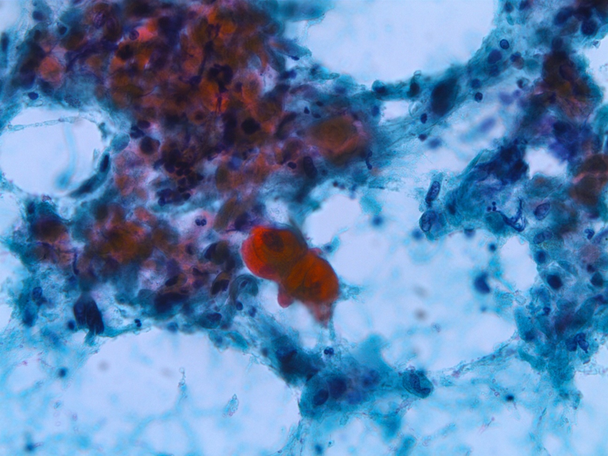 角化型の扁平上皮癌の細胞像