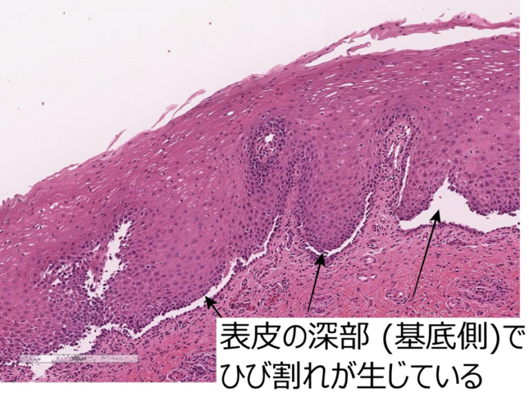 115D60 天疱瘡、類天疱瘡を含む水疱性疾患の鑑別 – 病理の広場