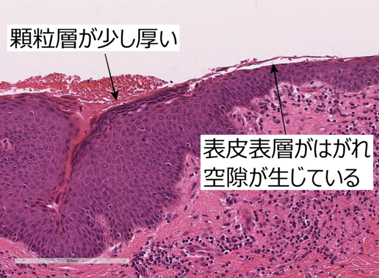 115D60 天疱瘡、類天疱瘡を含む水疱性疾患の鑑別 – 病理の広場