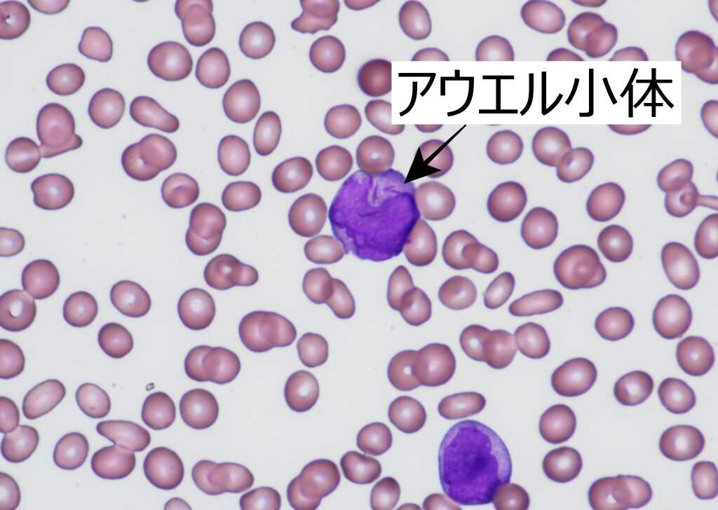 APL, M3の血液像