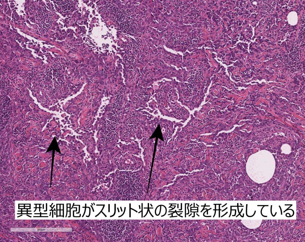 血管肉腫の組織像解説