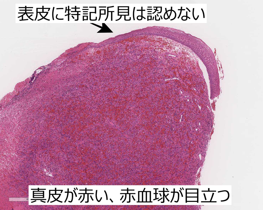 Kaposi肉腫の組織像解説