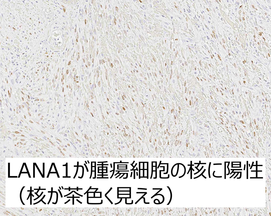 Kaposi肉腫の免疫組織化学（免疫染色）、LANA1