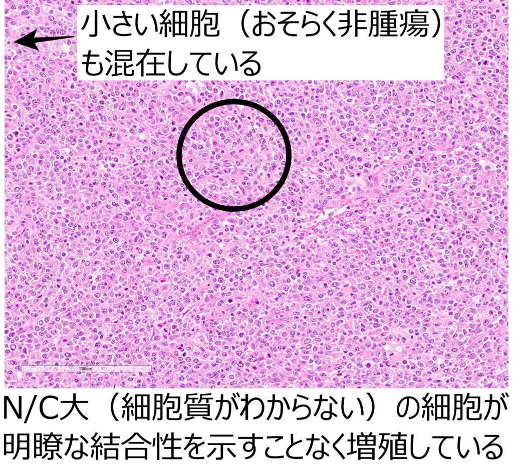 悪性リンパ腫拡大解説