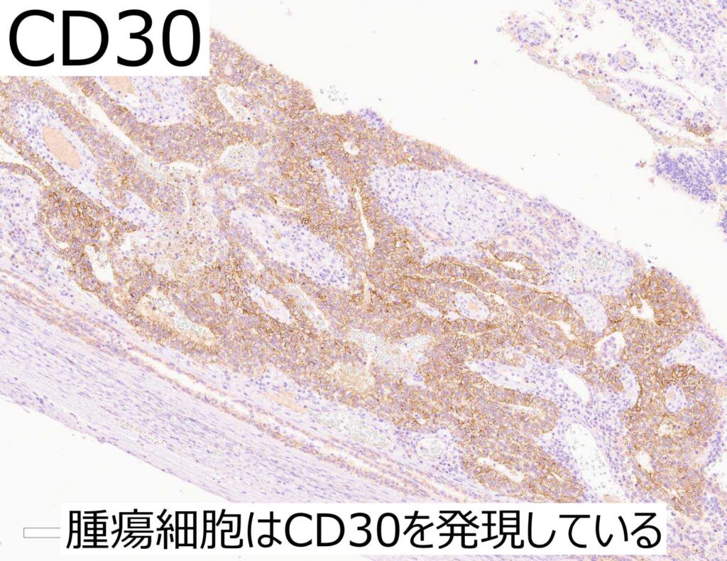 胎児性癌組織像CD30