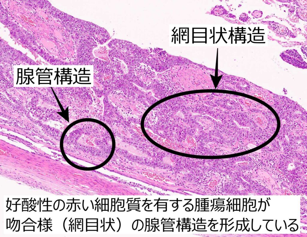 胎児性癌組織像解説