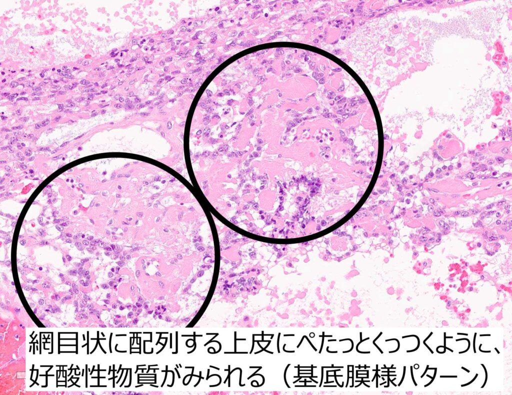 硝子膜様パターン解説