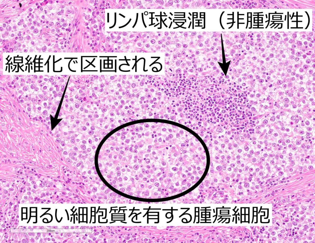 セミノーマ組織像拡大その2解説 