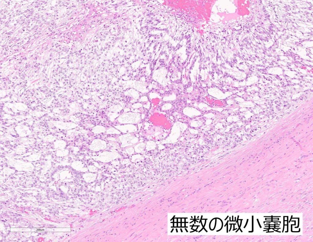 卵黄嚢腫瘍組織像拡大解説