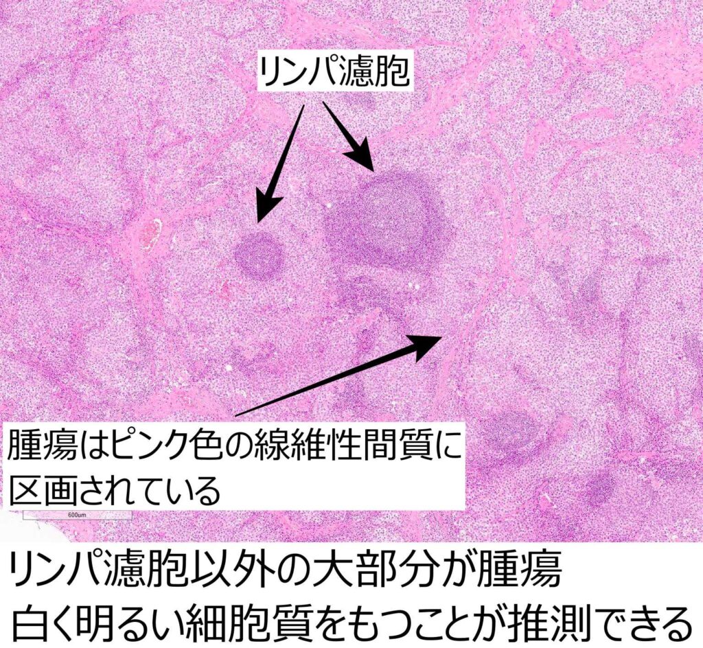 セミノーマ解説