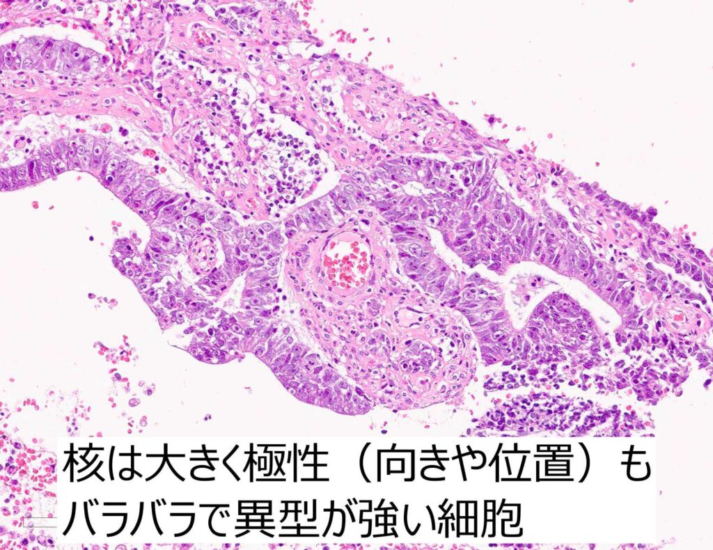 胎児性癌組織像拡大解説 