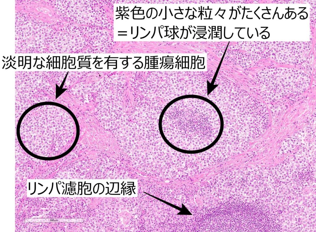 セミノーマ組織像拡大解説 