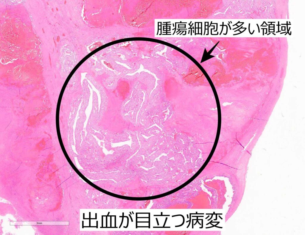 絨毛癌弱拡大解説