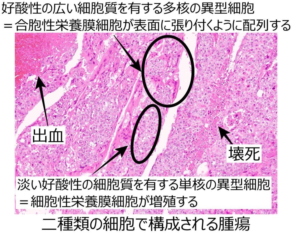 絨毛癌拡大解説