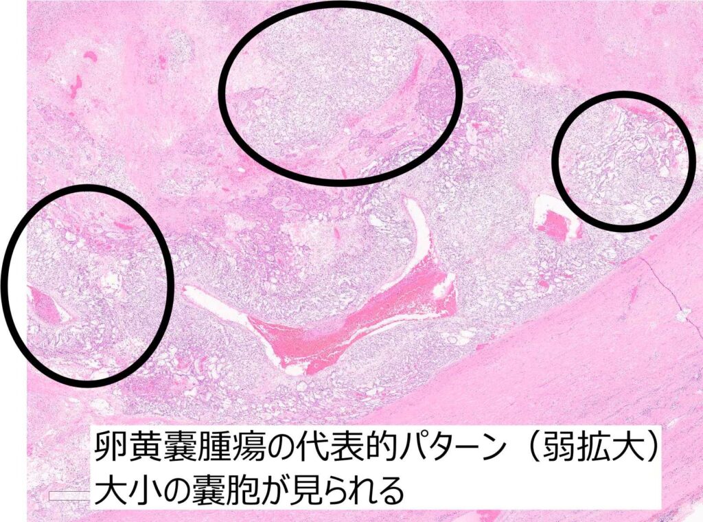 卵黄嚢腫瘍組織像解説