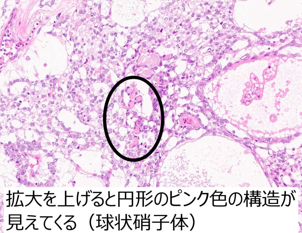 球状硝子体解説